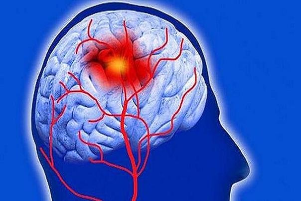 سکته مغزی در زمان طلایی قابل درمان است