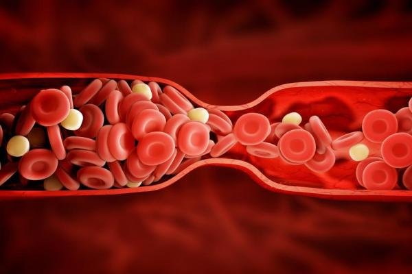 سندروم متابولیک موجب بروز مجدد لختگی خون می شود