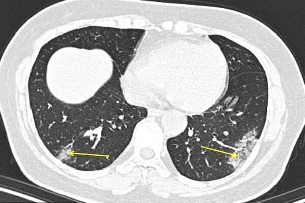تشخیص سریع ابتلا به کرونا با سی تی اسکن