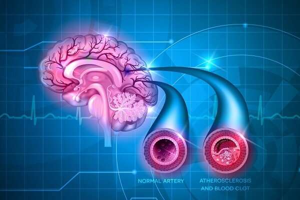 آزمایش خون سکته‌های مغزی مخفی را تشخیص دهد